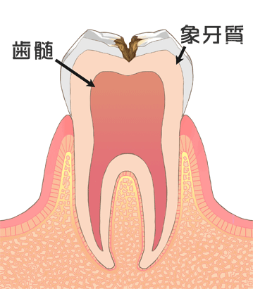 虫歯の症状図