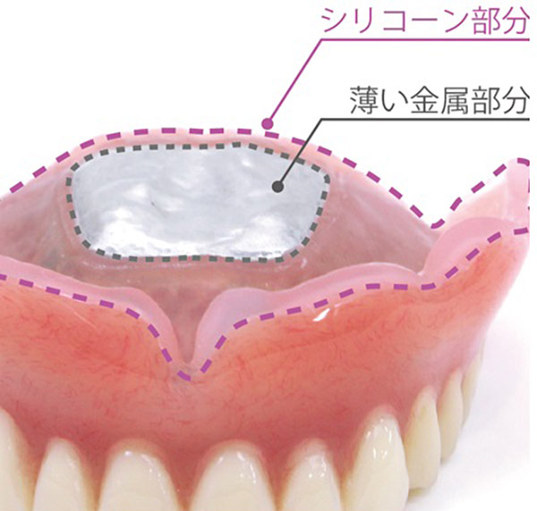 コンフォート義歯写真